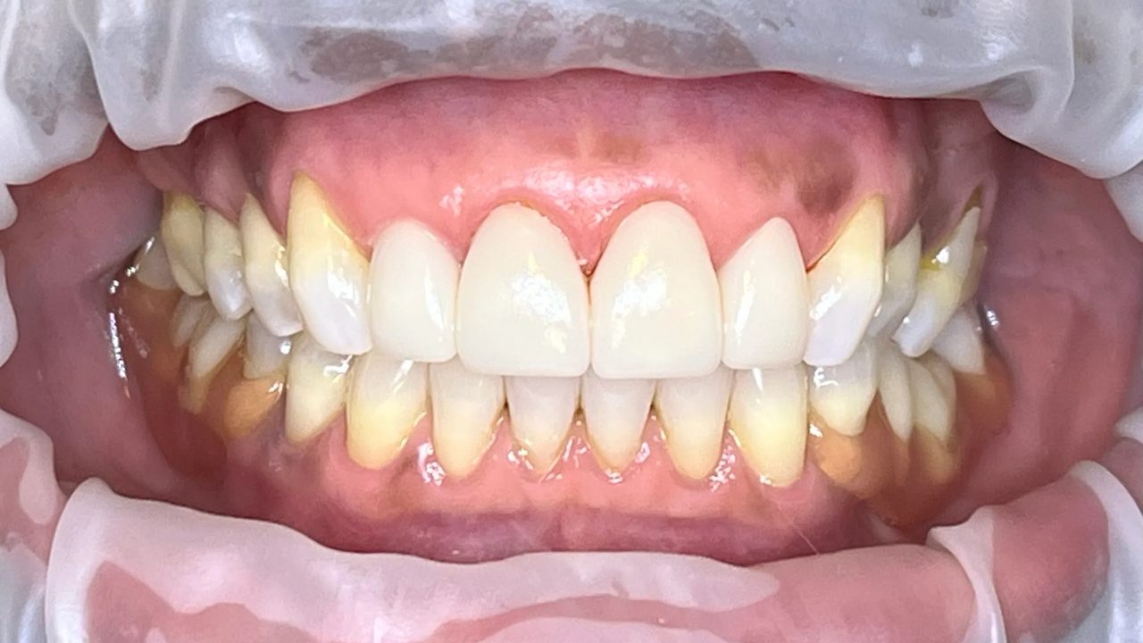 Smile case 5 after treatment at Rovel Dental