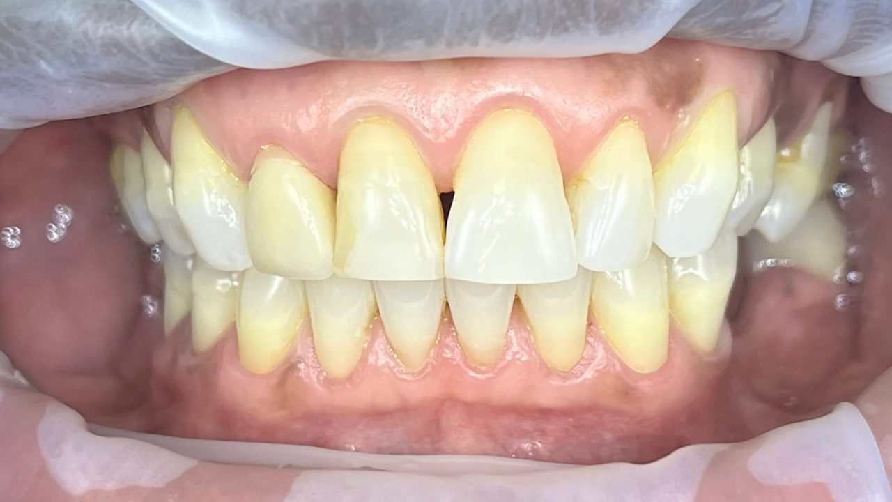 Smile case 5 before treatment