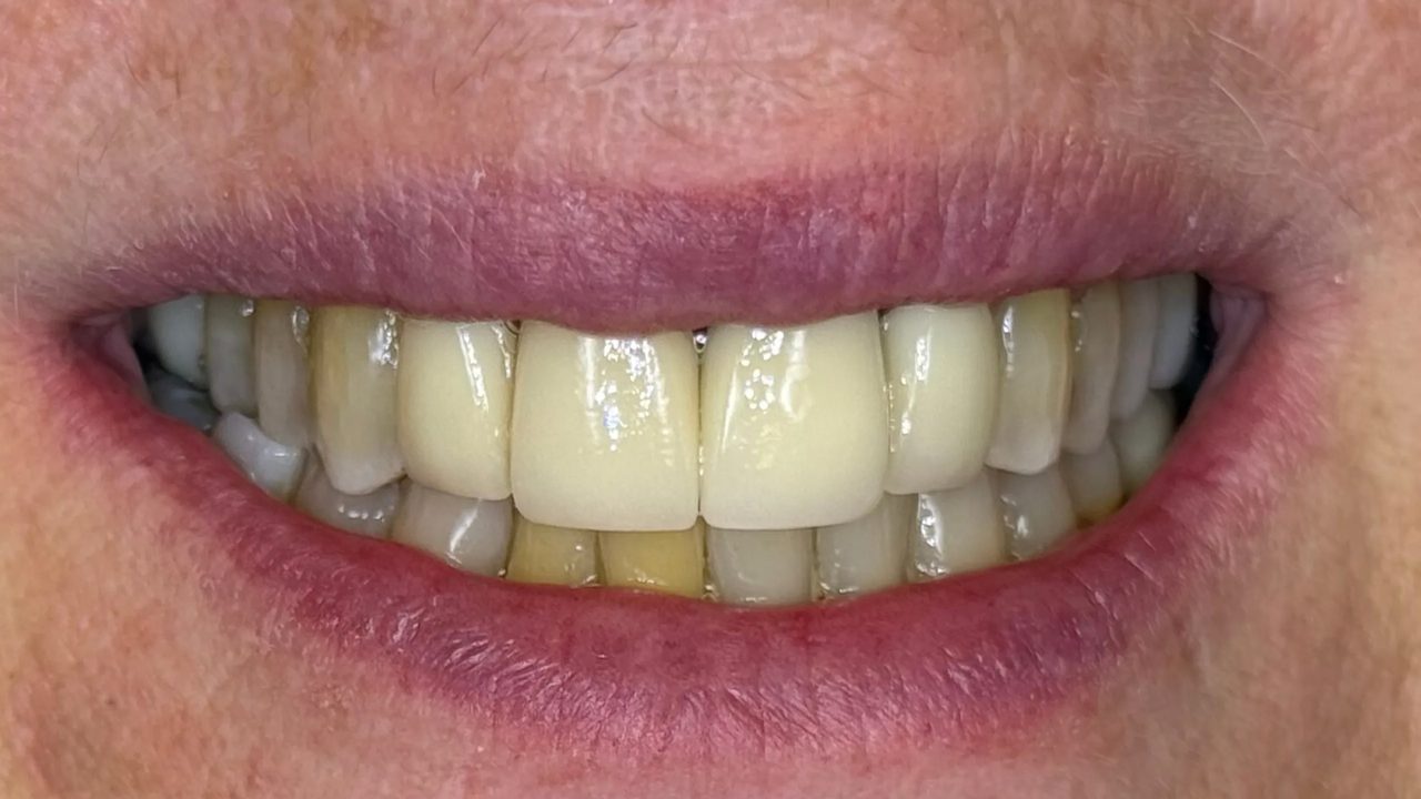Smile case 6 after treatment at Rovel Dental