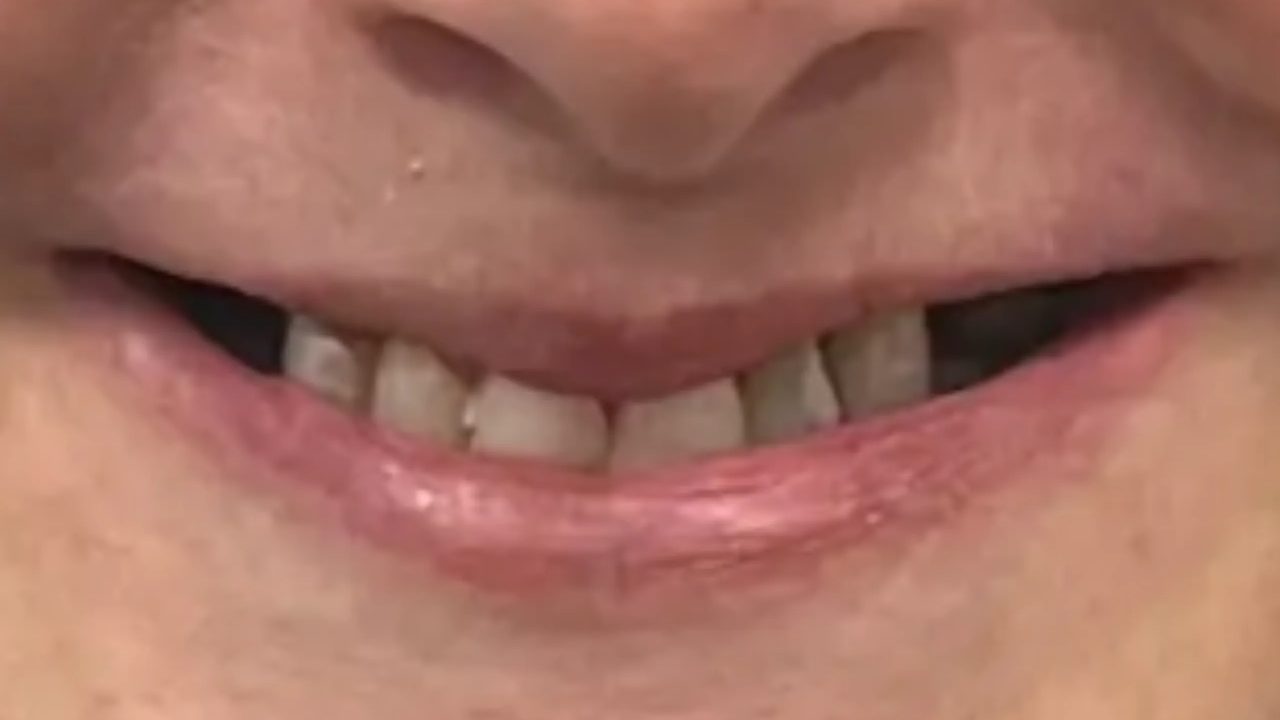 Smile case 11 before treatment