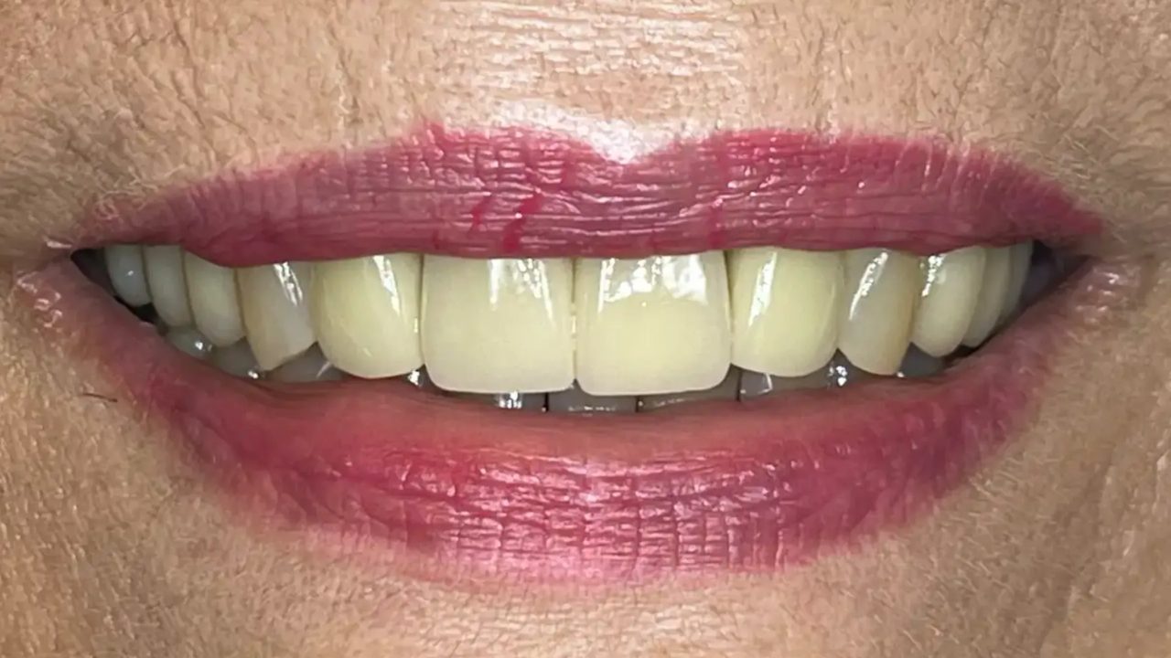 Smile case 17 after treatment at Rovel Dental