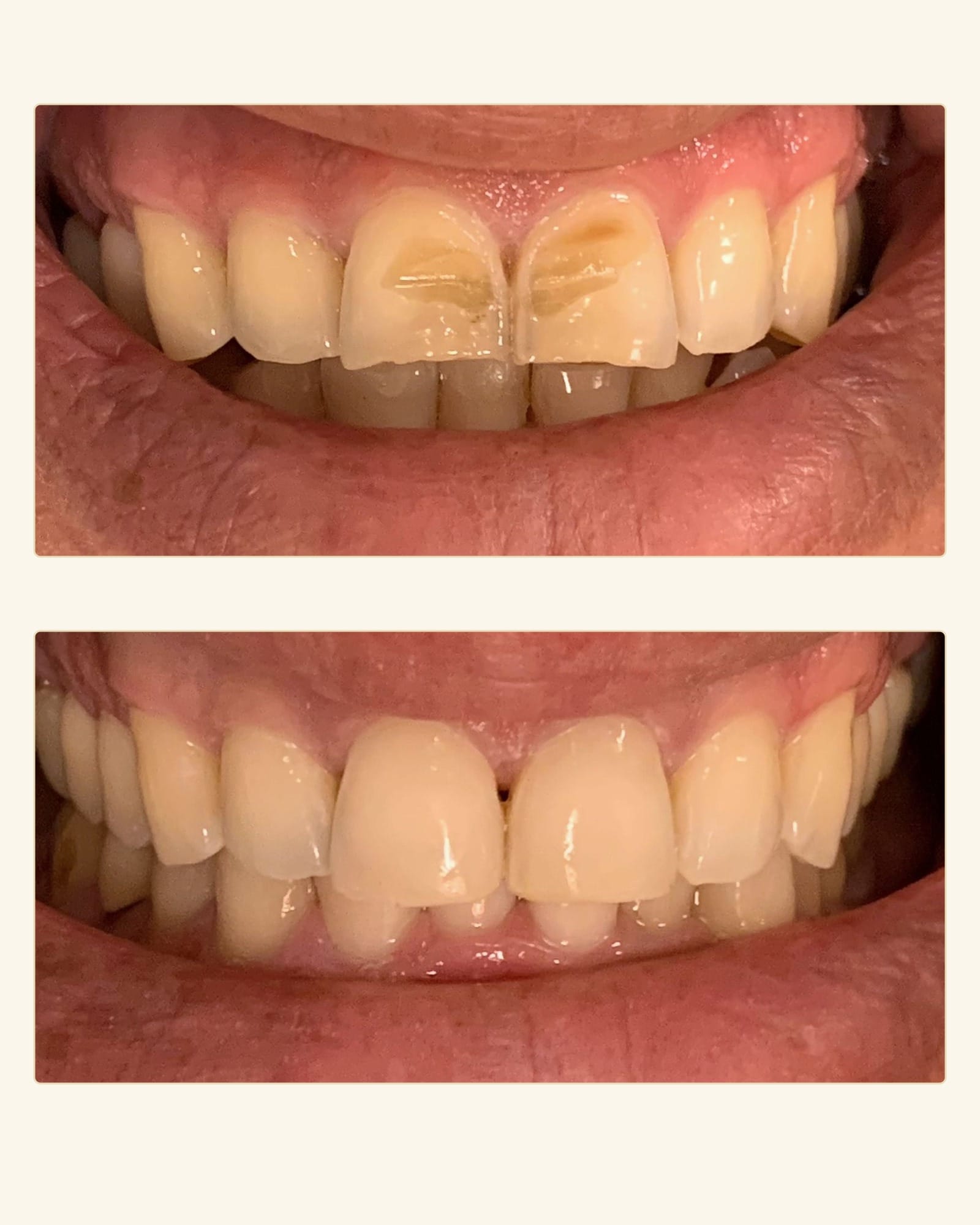 Before and after veneers on worn front teeth at Rovel Dental in Palm Springs, FL